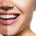 Snowhite Teeth Whitening – official website – harga – farmasi